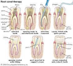 Step by step how root canal therapy works