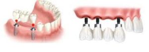 Rendering of how dental crowns are installed