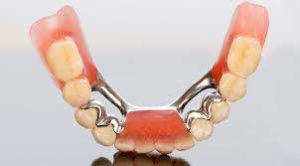 Close up shot of dental bridges