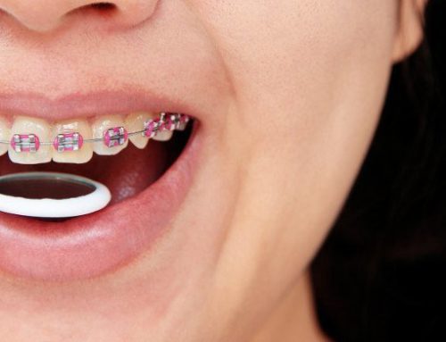 5 Reasons Why Braces Improves Oral Health