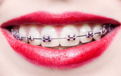 How Can I Clean My Teeth with Braces