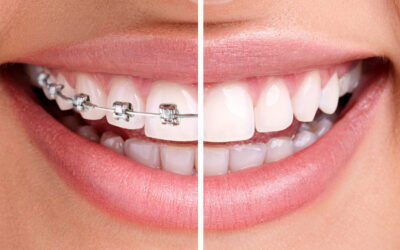 Invisalign vs Traditional Braces
